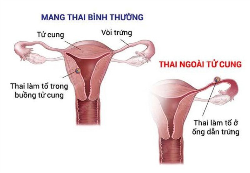 Mang thai ngoài tử cung là như thế nào
