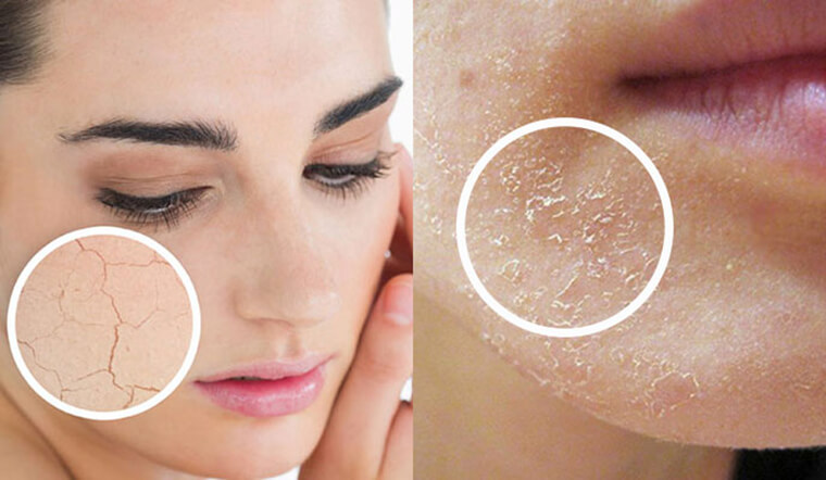 nguyên nhân gây nên da thiếu nước và da thiếu ẩm