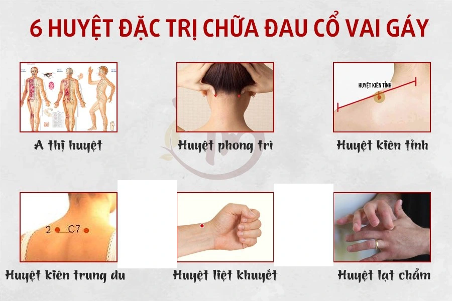 Sáu huyệt đặc trị đau cổ vai gáy cơ bản